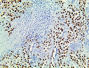 anti-prame, anti prame, MAPE, melanoma antigen preferentially expressed in tumors, preferentially expressed antigen in m MAIN