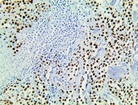 anti-prame, anti prame, MAPE, melanoma antigen preferentially expressed in tumors, preferentially expressed antigen in m MAIN