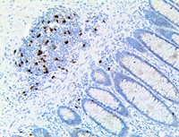 thymidylate synthase, anti-thymidylate synthase, ts, anti-ts MAIN