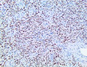 hhv8, hhv-8, hhv 8, anti-hhv8, anti-hhv8, anti hhv-8, anti-hhv-8, Kaposi s sarcoma associated herpesvirus, KSHV, eighth THUMBNAIL