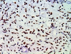 atrx, anti-atrx, α-thalassemia mental retardation syndrome X-linked MAIN