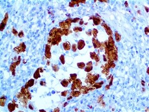 alk1 alk-1 anti-alk1 anti-alk-1 alk anti-alk cd246 anti-cd246 anaplastic lymphoma kinase antibody immunohistochemistry i MAIN