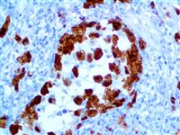 alk1 alk-1 anti-alk1 anti-alk-1 alk anti-alk cd246 anti-cd246 anaplastic lymphoma kinase antibody immunohistochemistry i MAIN