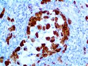 alk1 alk-1 anti-alk1 anti-alk-1 alk anti-alk cd246 anti-cd246 anaplastic lymphoma kinase antibody immunohistochemistry i THUMBNAIL