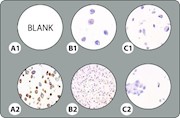 5-Core BRAF V600E Cell Line Microarray THUMBNAIL