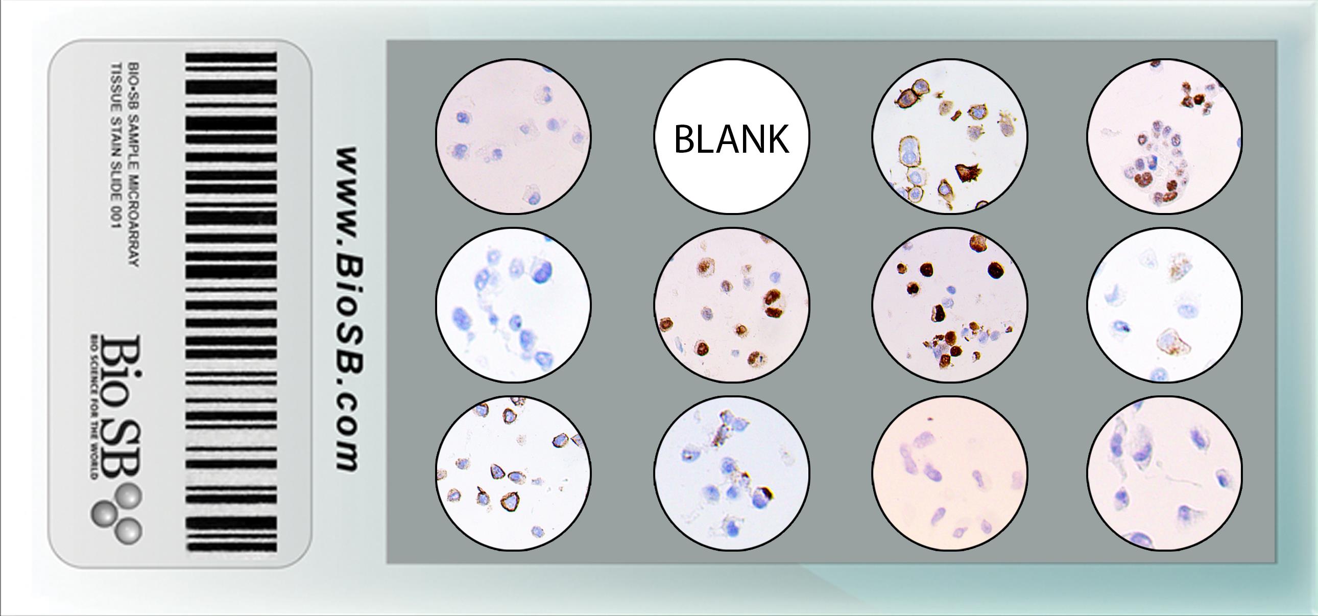 Cancer Human Cell Line Microarrays