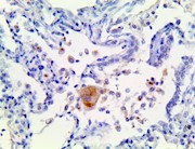 il-6, il6, anti-il6, anti-il-6, il6 antibody, anti-il-6 antibody, cytokine storm, cytokine storm syndrome, cytokine stor THUMBNAIL