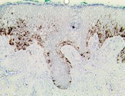 TintoFast Melanoma Cocktail: HMB-45 Mart-1 Tyrosinase (HMB-45, A103 & BSB-6), MMab THUMBNAIL