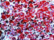Melanoma PNL2 (PNL2), MMab THUMBNAIL