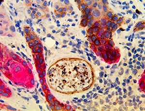PNI Carcinoma MultiDetector HRP/AP Kit MAIN