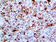 Renal Cell Carcinoma (PN-15), MMab THUMBNAIL