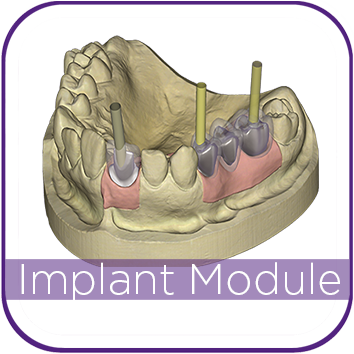 Exocad Implant Module MAIN