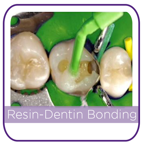 Resin Dentin Bonding THUMBNAIL