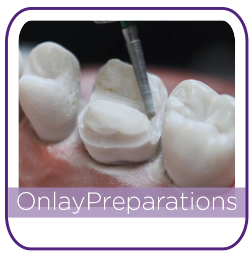 Onlay Preparations MAIN