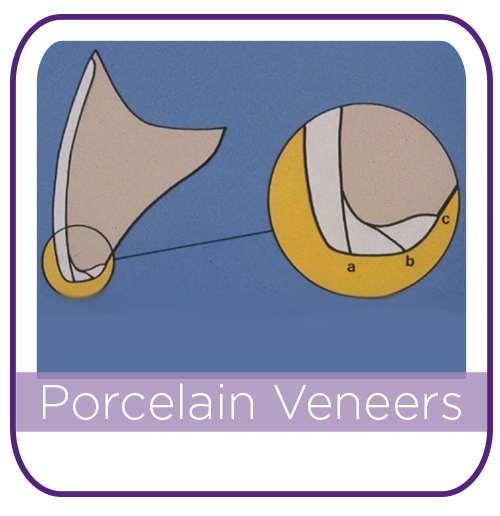 Porcelain Veneers THUMBNAIL